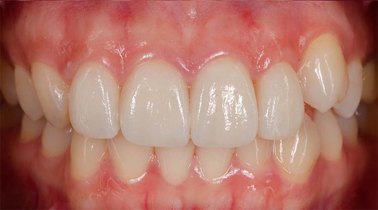 A Quick Fix for Minor Cosmetic Dental Problems - After