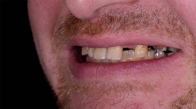 Two implants were used to replace the two front teeth - Before